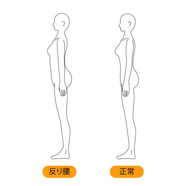 反り腰の方のイメージ